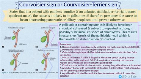 sinal de courvoisier terrier